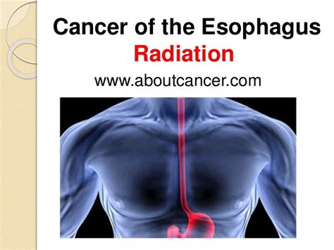 esophageal cancer radiation